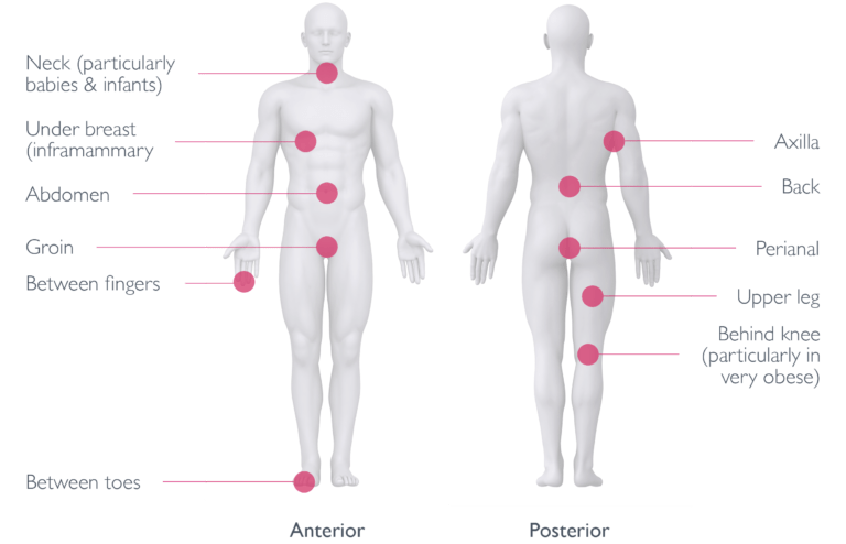 Masd Rash OSKA | Pressure Care Experts
