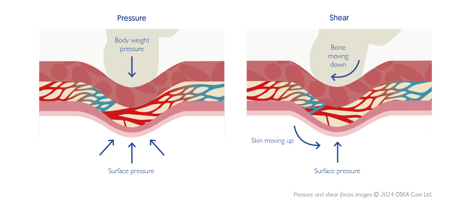 bed sores and pressure ulcers. Diagram showing how pressure and shear forces affect the skin and underlying tissue.