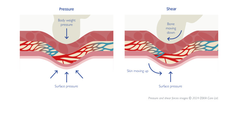 bed sores and pressure ulcers. Diagram showing how pressure and shear forces affect the skin and underlying tissue.
