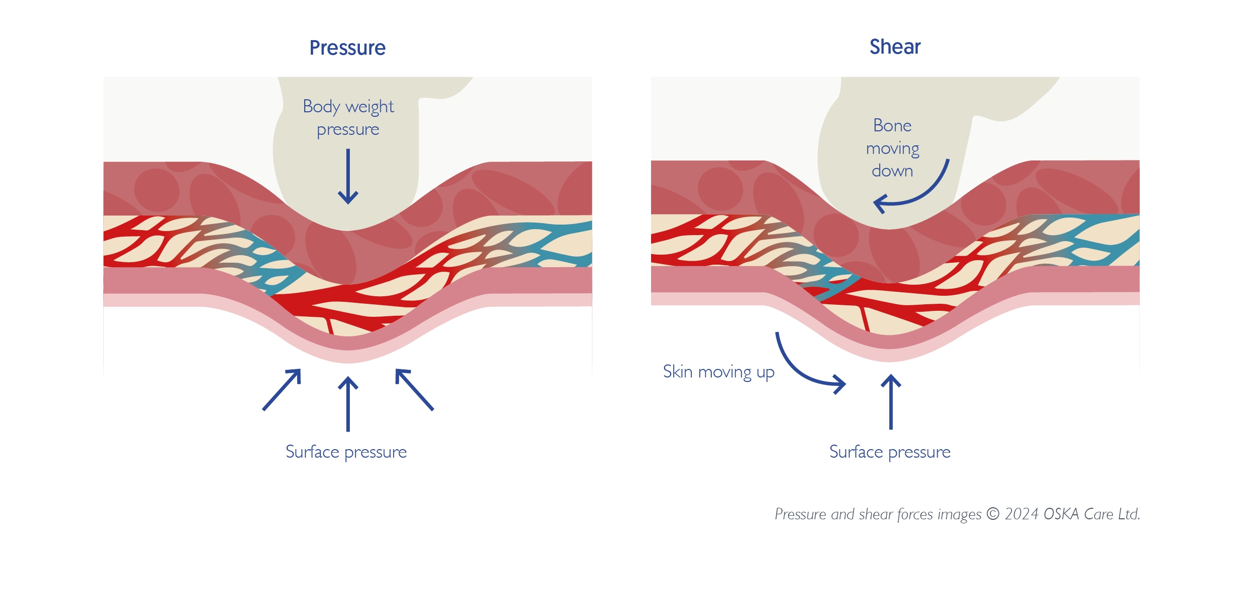 bed sores and pressure ulcers. Diagram showing how pressure and shear forces affect the skin and underlying tissue.